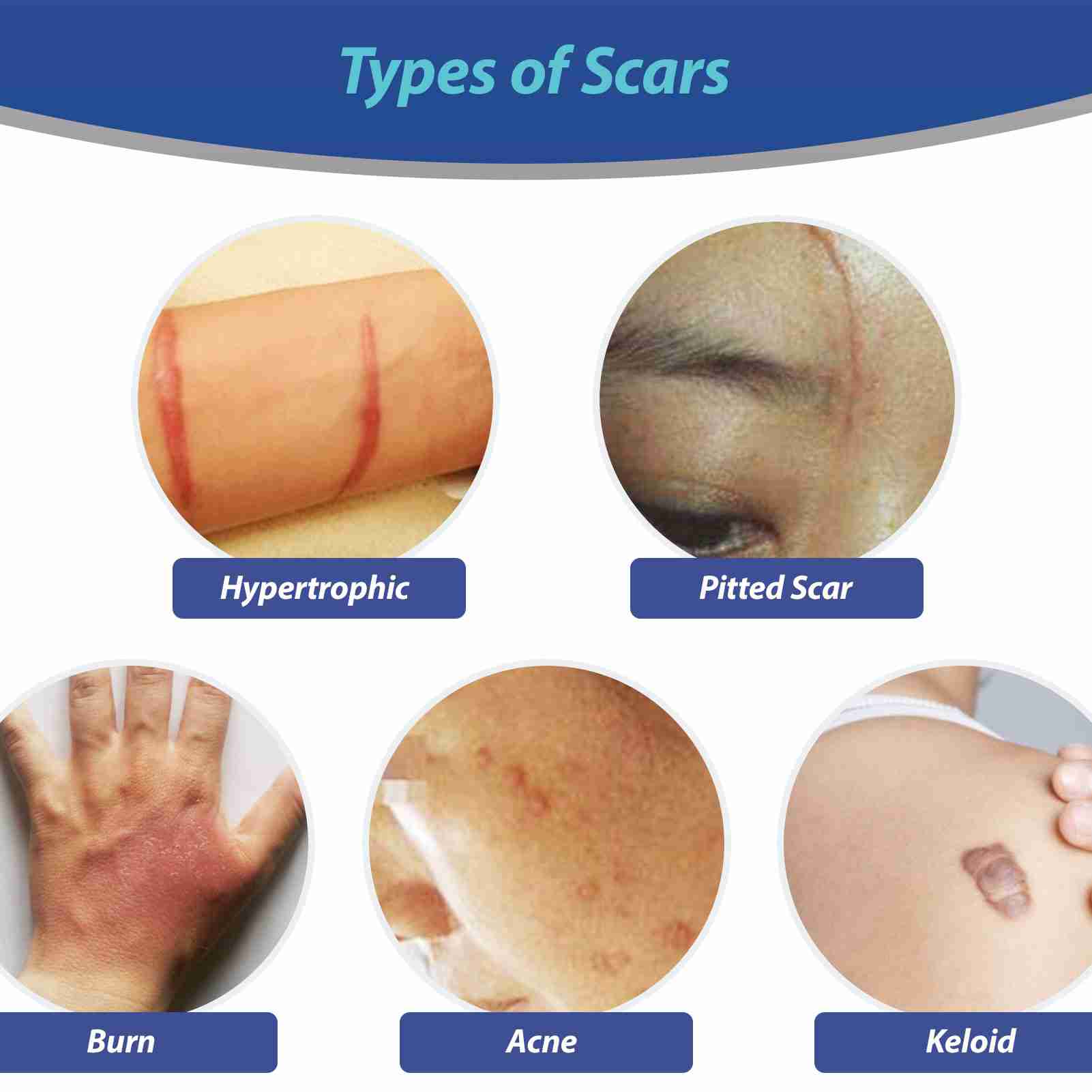 scar-removal with discount code