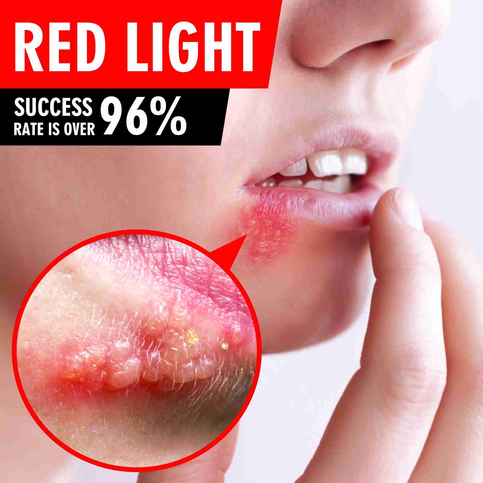 canker-sore-treatment-device with cash back rebate