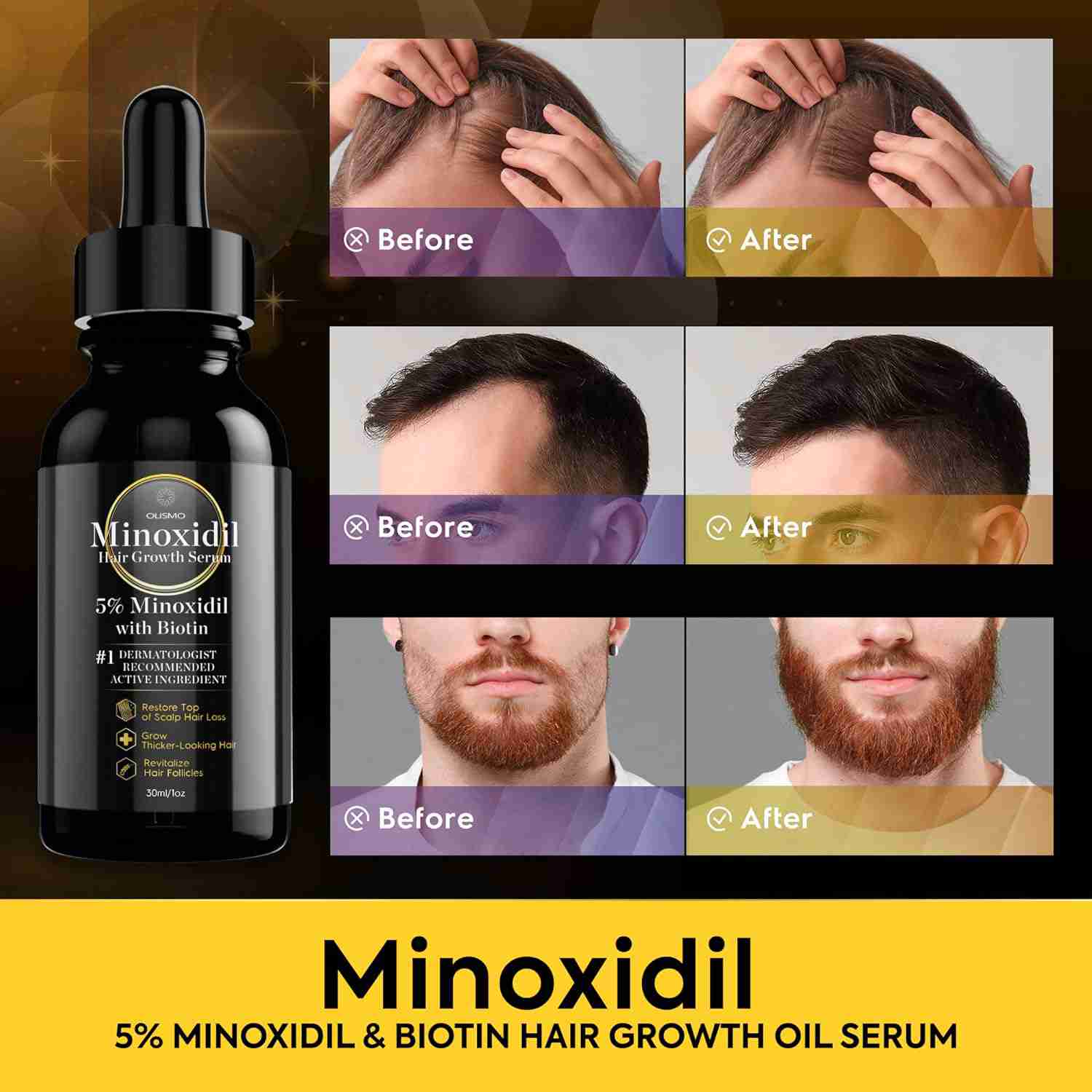 minoxidil-hair-growth with discount code