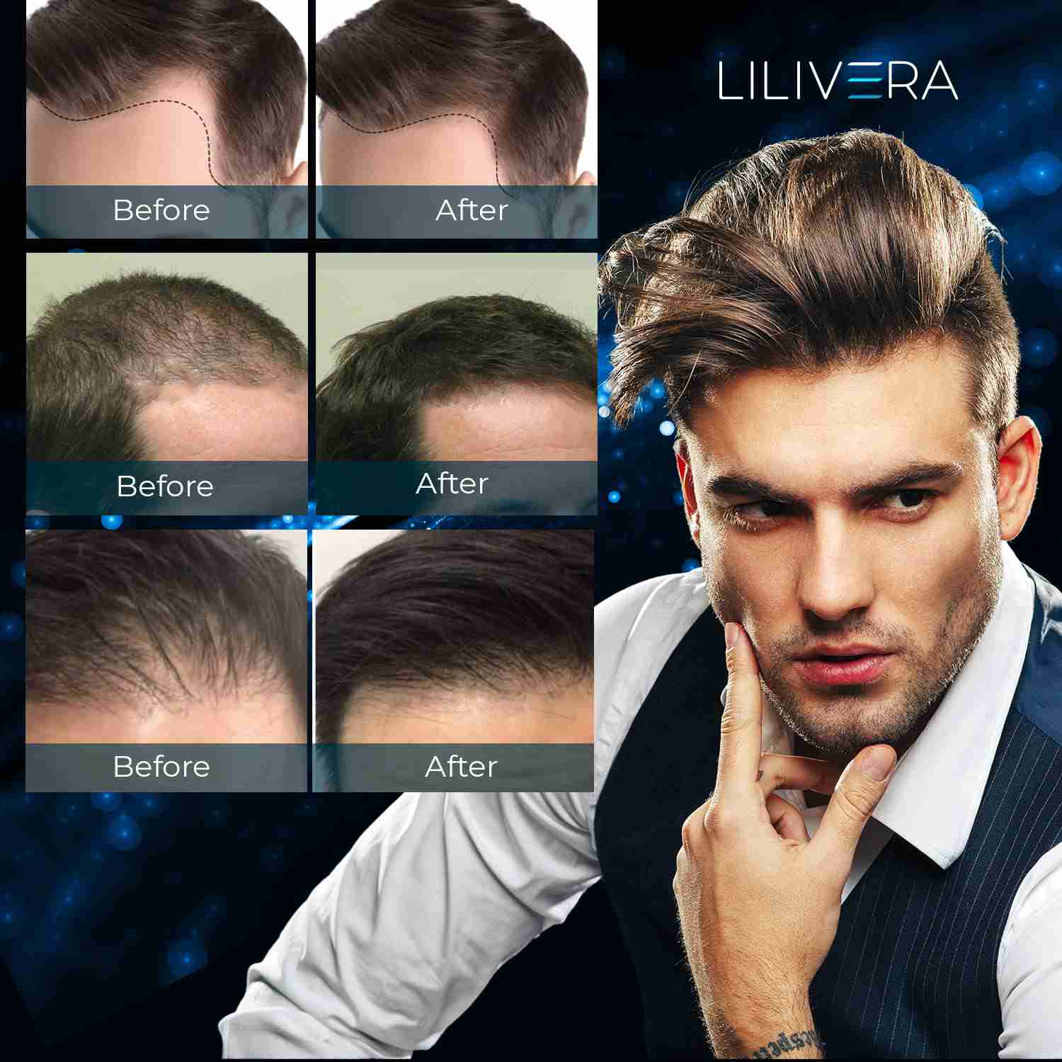 5-minoxidil-for-men-hair-growth-spray for cheap